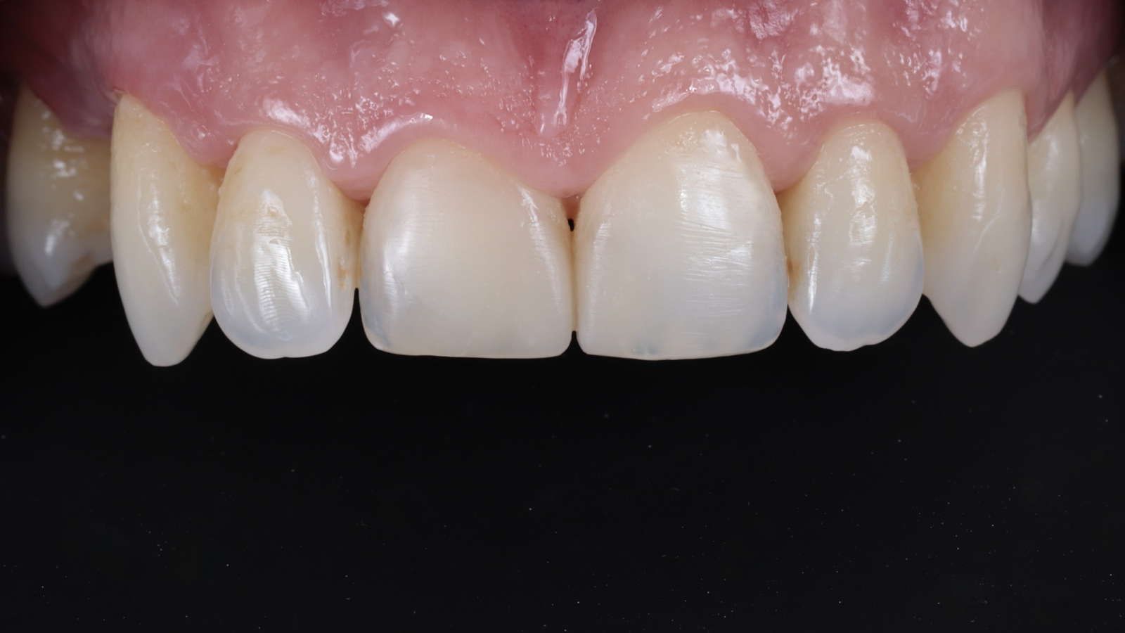 A clinical case using Venus Pearl Pure Shades by Dr Riccardo Baratto 