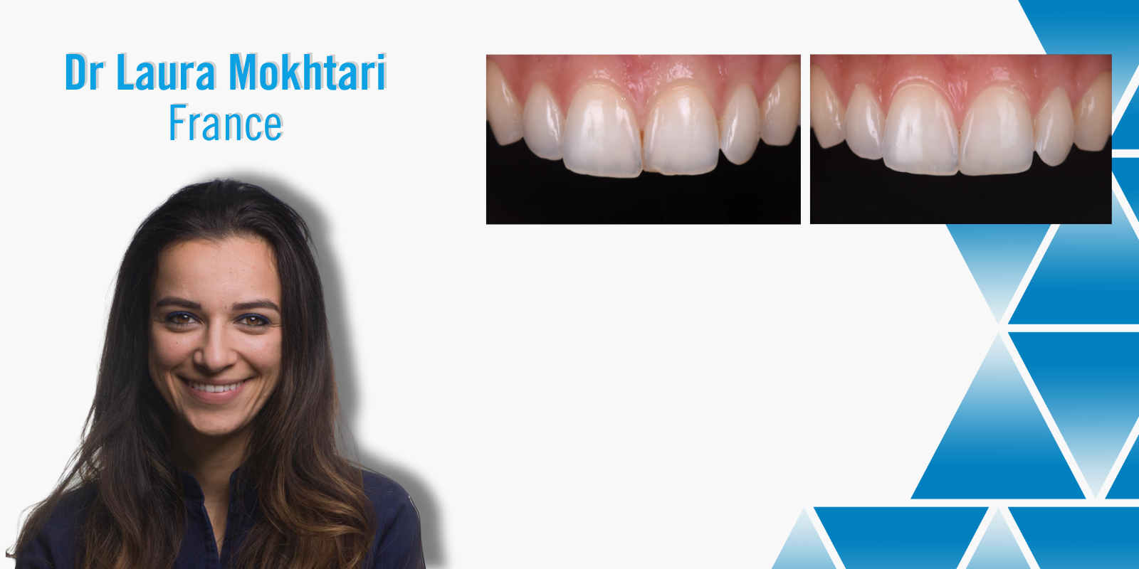 Transform smiles with these anterior techniques