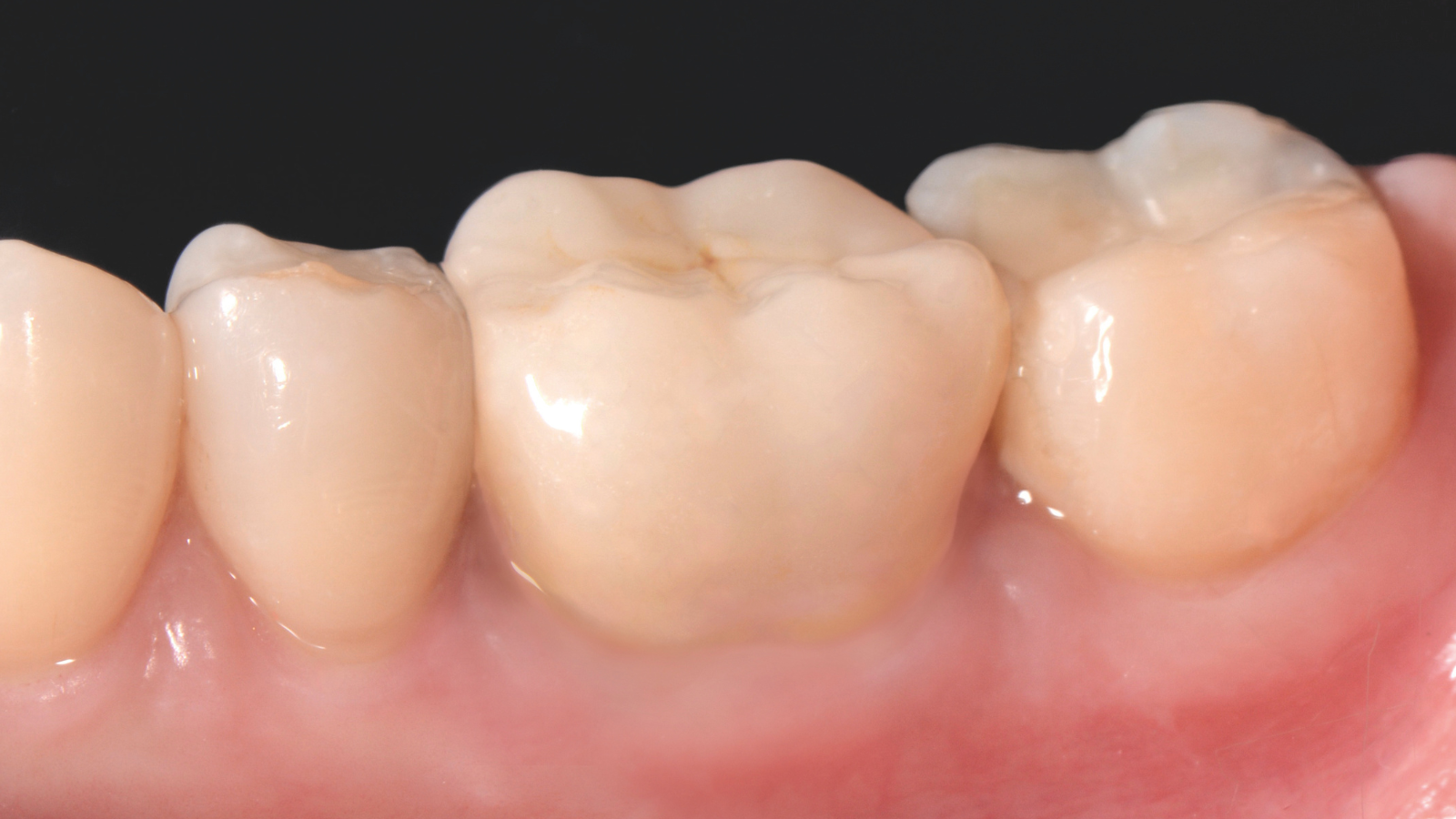 RetraXil 6
