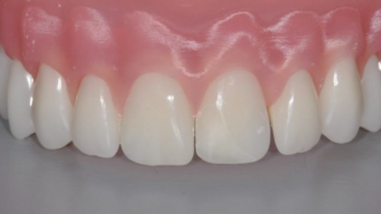 Restorations in the A1 model