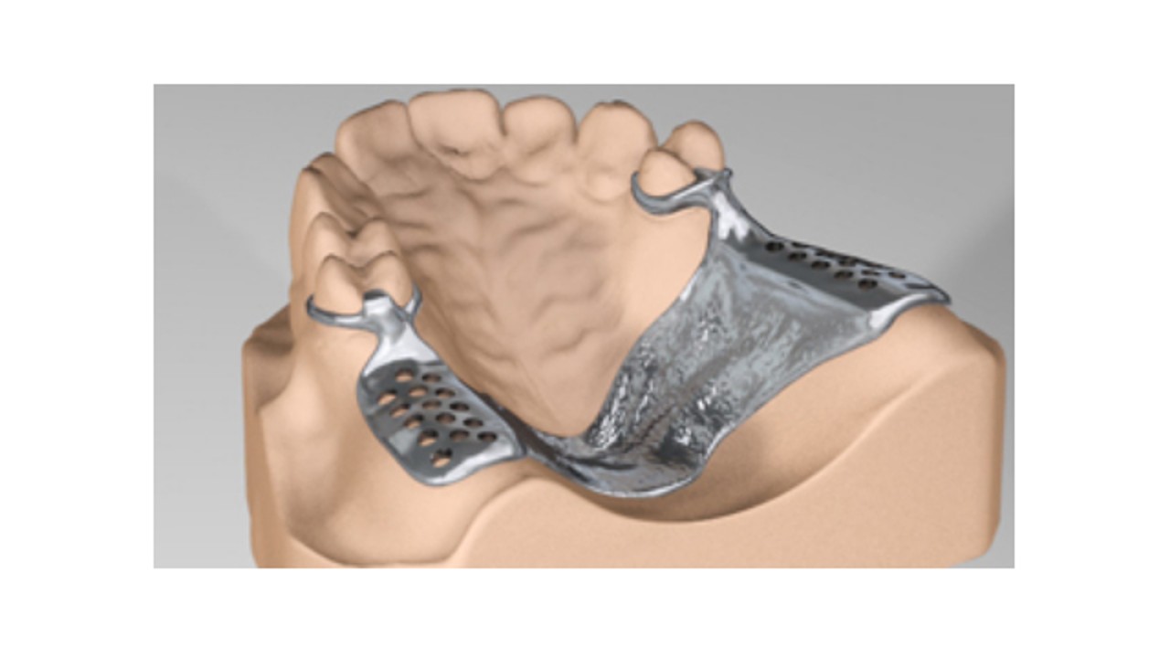 Part cast. Балтика Denture creator System. Hystectomic partial MCK sergery.