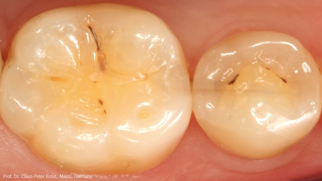 „Hidden caries“ below marginal ridge of 2nd lower right premolar.