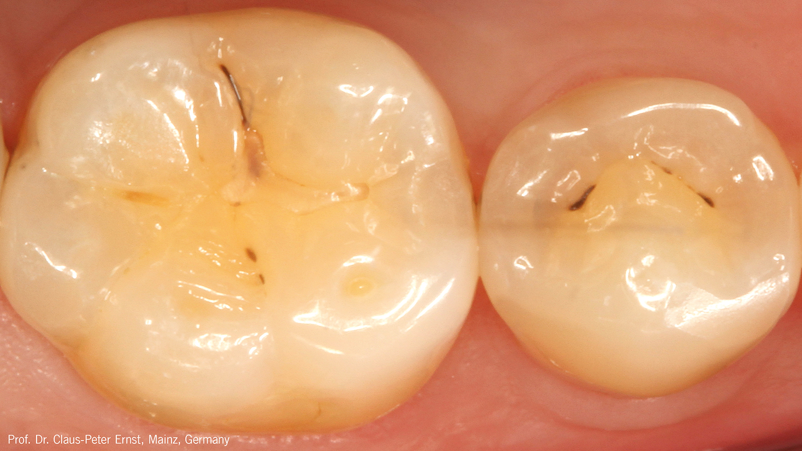 „Hidden caries“ below marginal ridge of 2nd lower right premolar.
