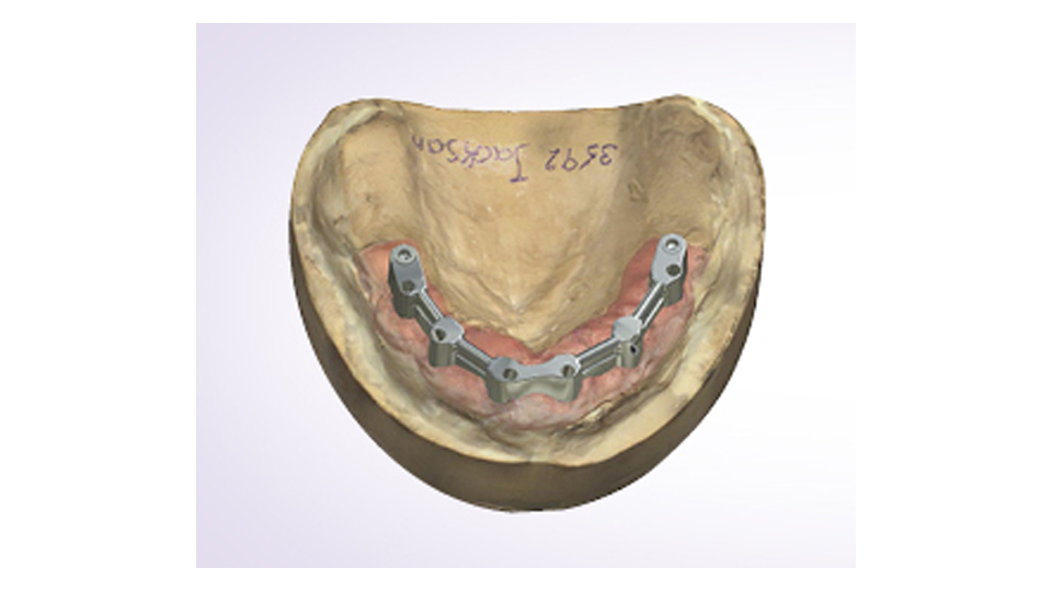 Implant Bars & Bridges™