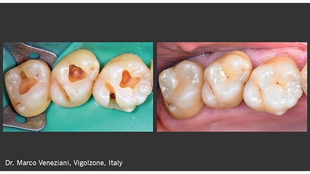 Single-shade restorations of carious lesions in the posterior region.