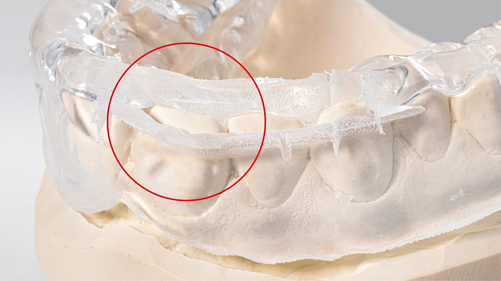 Poorly-fitting “Boil & Bite” Mouth Guards