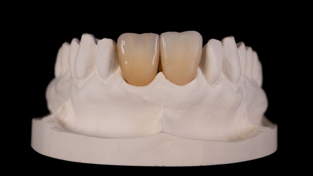 Creating transparency and contrast in incisal area