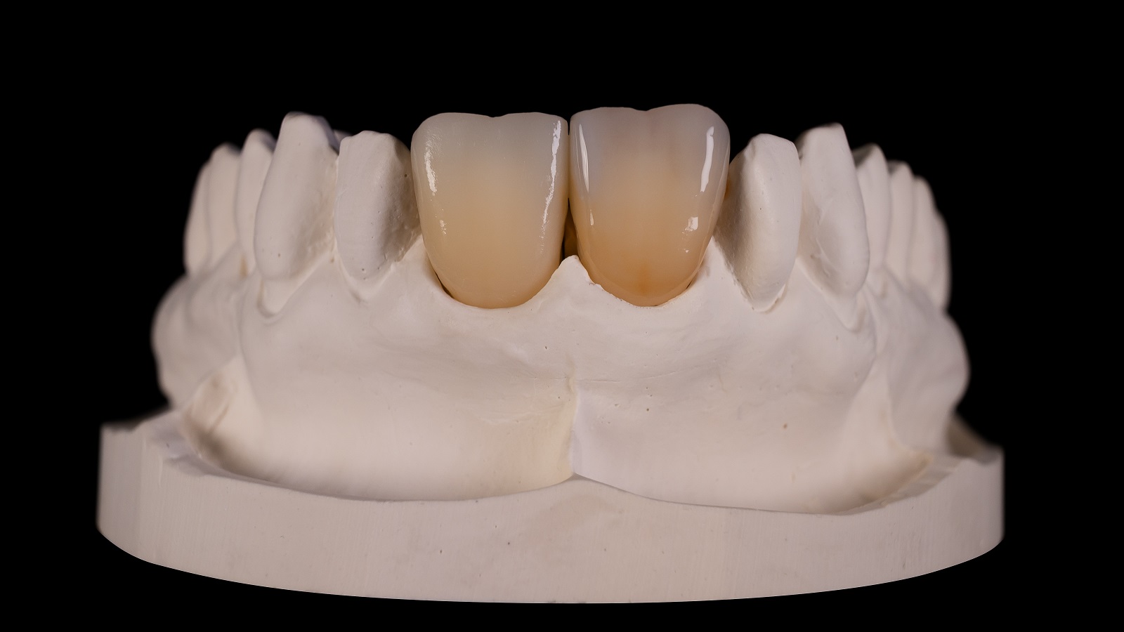 Apply HeraCeram cre-active 2D Anthracite distally and blend out towards the incisal edge.