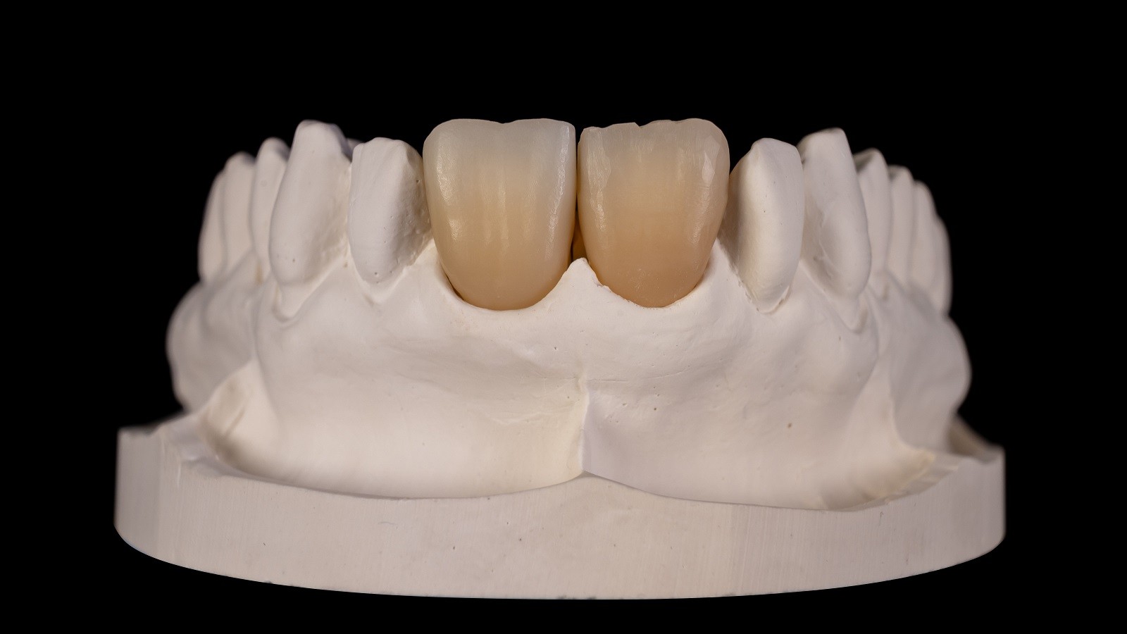 Minimal reduced zirconia multi-layer frame in A3