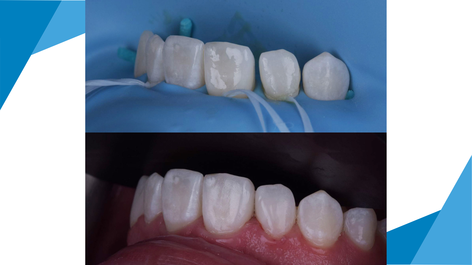 Reshaping of tooth 12 using Venus Diamond Flow Pure LIGHT