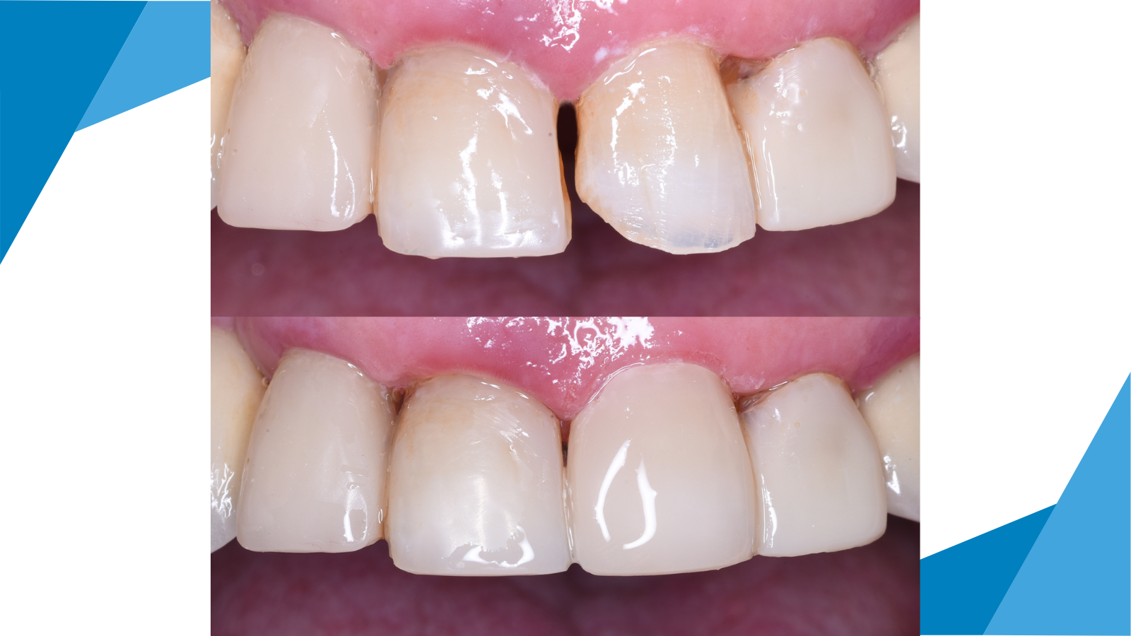 Direct repair of fractured 10-year-old composite veneer at tooth 21