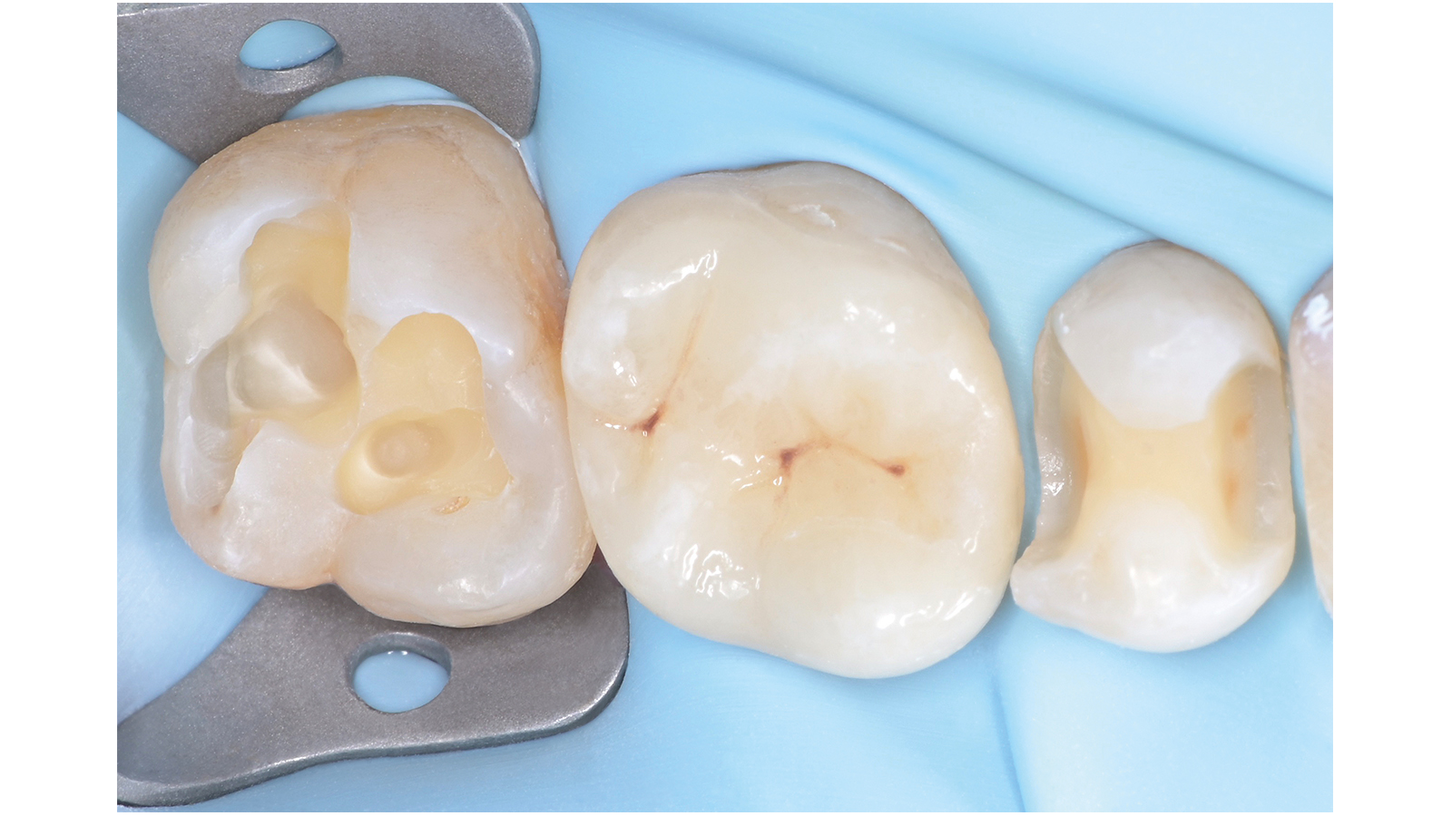 Venus Pearl ONE case by Dr. Edoardo Fossati, Turin, Italy