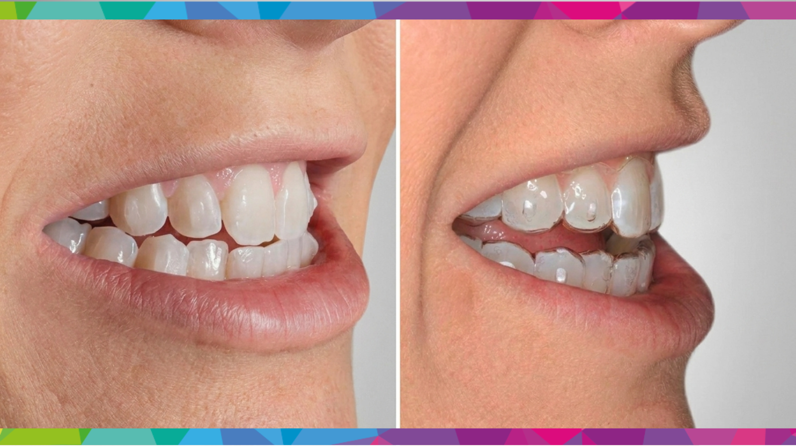 Aligner