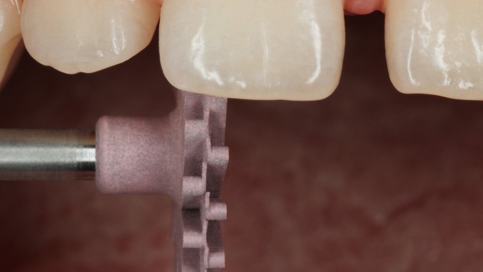 Incisal