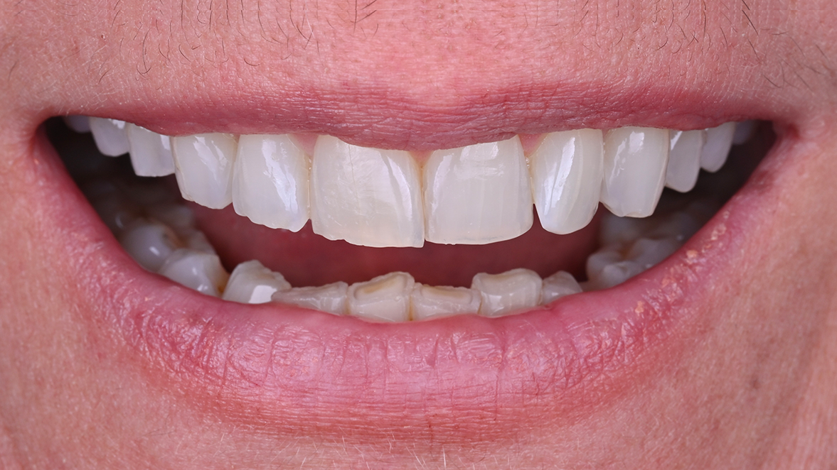 Kulzer Vivida_Case by Dr. Edoardo Fossati, Italy_after