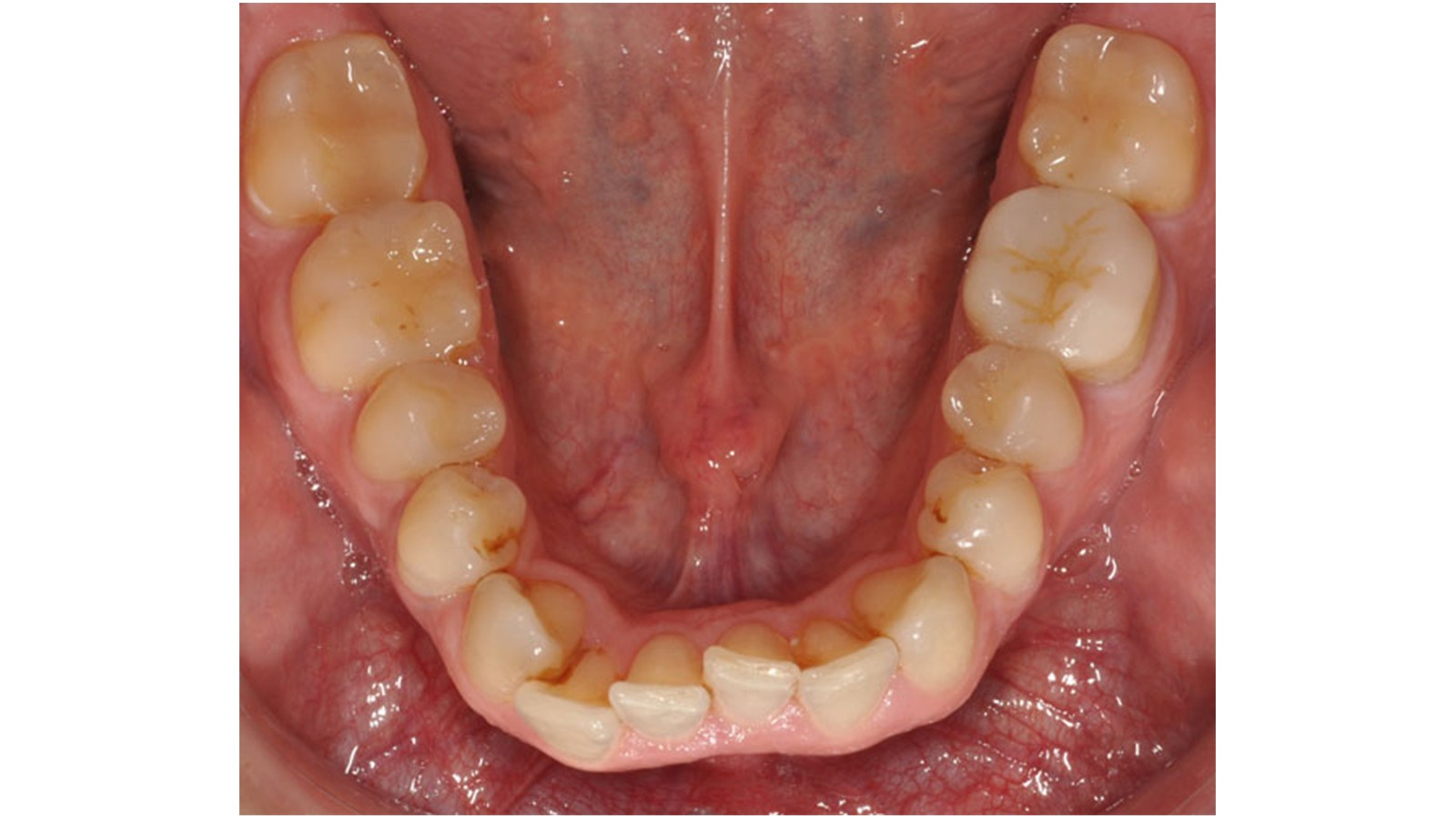 Mandibular dental arch