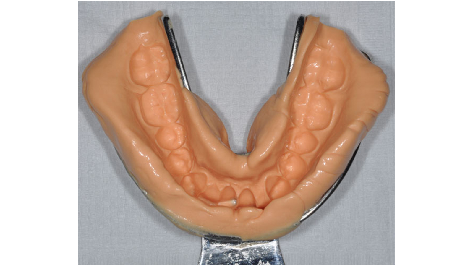Perfect result of mandibular impression