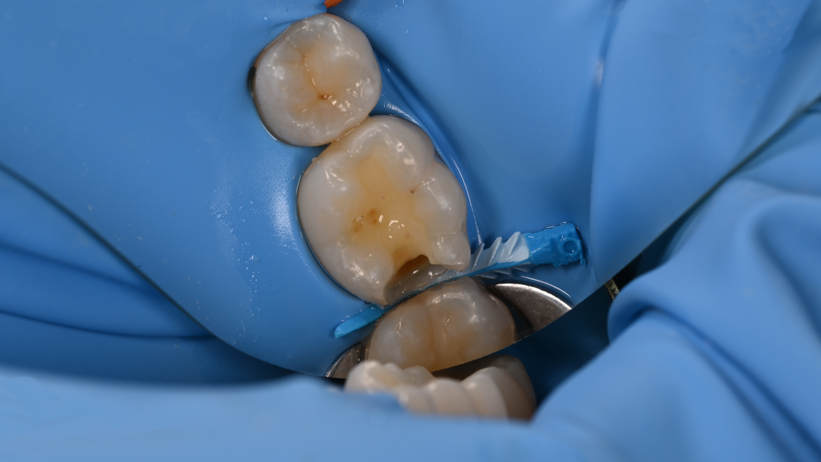 Final preparation with rubber dam