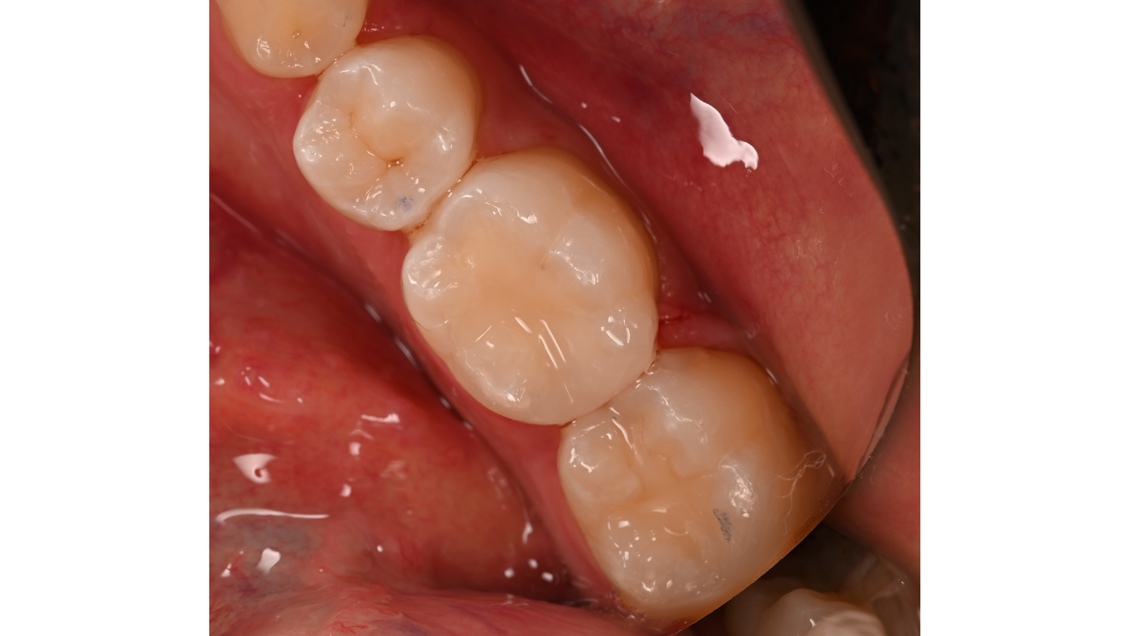 Final result after restoration of carious lesion at tooth 36.