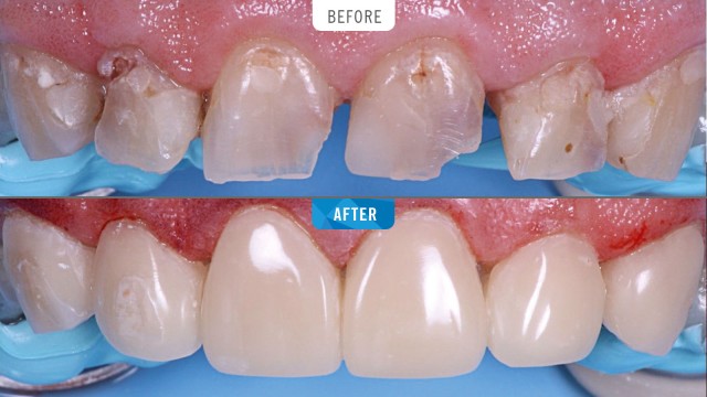 Restoration of strongly damaged anterior teeth with Venus Pearl MEDIUM.